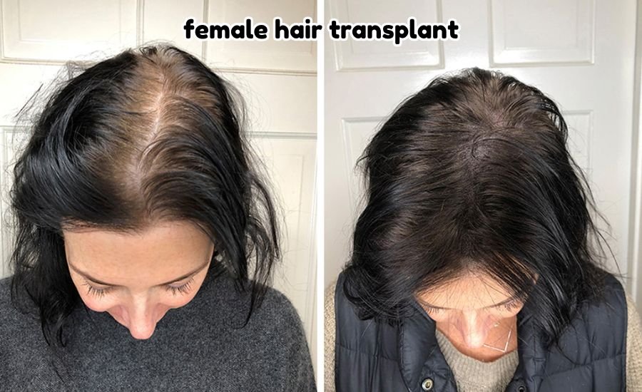 female hair transplant