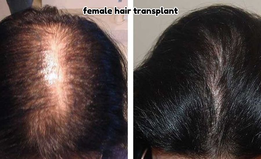female hair transplant