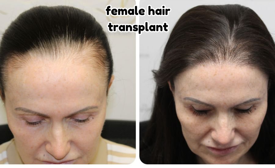 female hair transplant